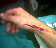 Ferrera, herida de 20 cms en el brazo derecho