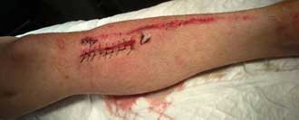 Buena evolución de El Fandi