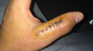 Aspecto actual del pulgar de Miguel Abellán.