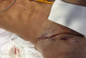 Estado actual de la herida de Escribano.