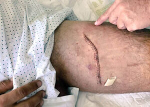 Aspecto de la herida de Fandiño.