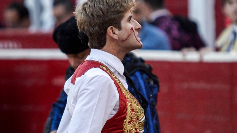 Adrián Villalba, "luxación acromio-clavicular izquierda tipo II" en Albacete