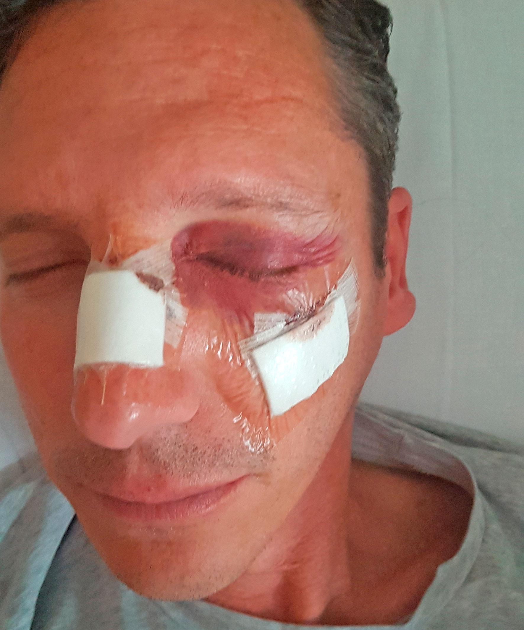 Reyes Mendoza sufre desprendimiento del globo ocular, fractura de la órbita ocular y parálisis del nervio de la cara