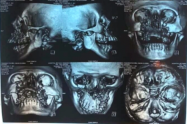 Hilda Tenorio, operada de 17 fracturas