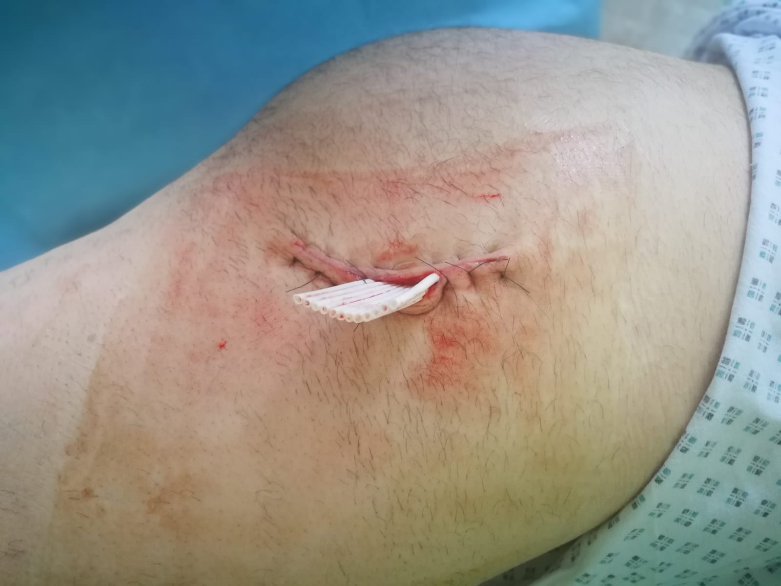 José Antonio Prestel, cornada de 20 cm en el glúteo