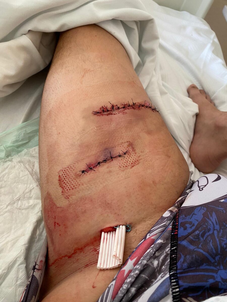 Buena evolución de El Adoureño, que pasa la noche sin fiebre