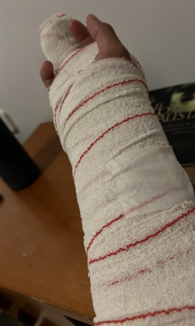 Leo Valadez sufre fractura de "falanges de la mano derecha"