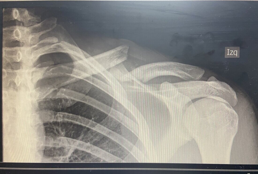 El Galo será intervenido este sábado de una fractura de clavícula