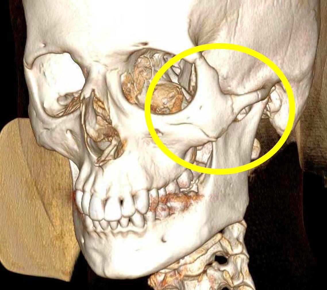 Martín Morilla, triple fractura en el pómulo izquierdo