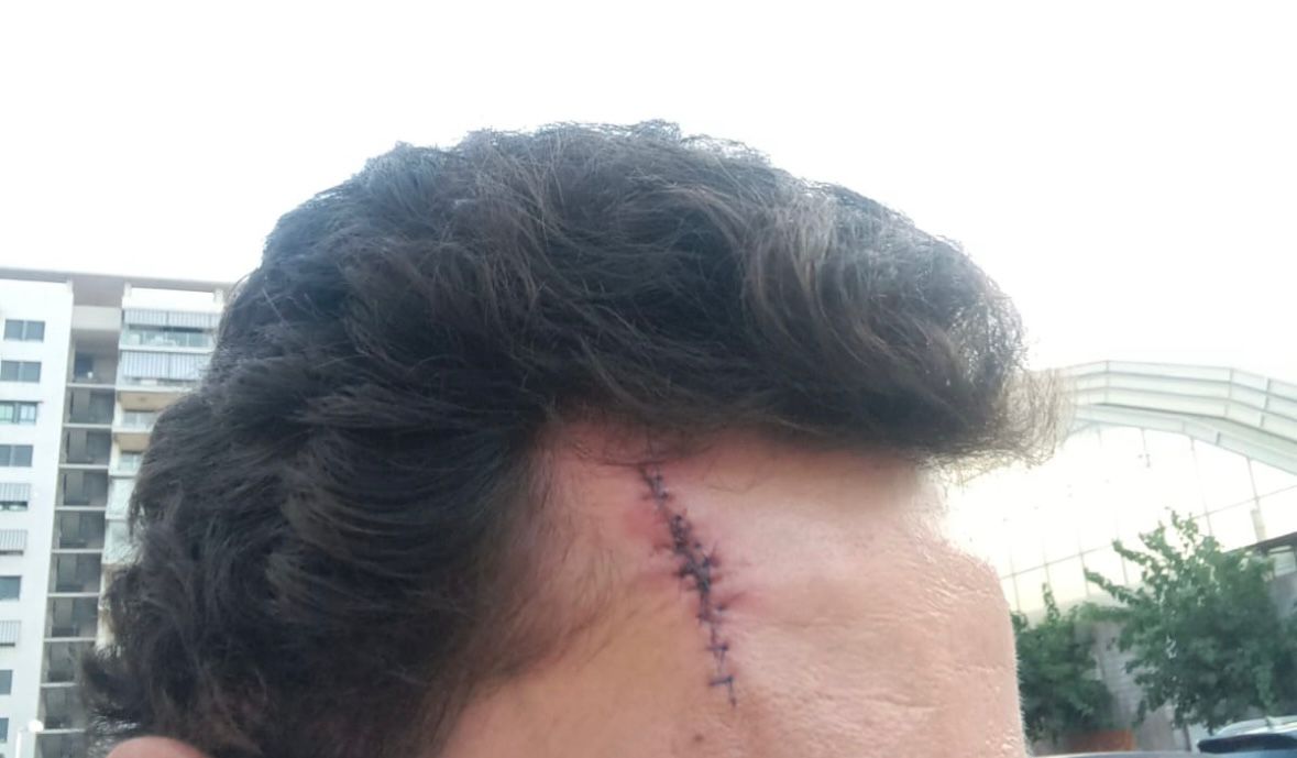 Leonardo Hernández operado con éxito de un cáncer de piel