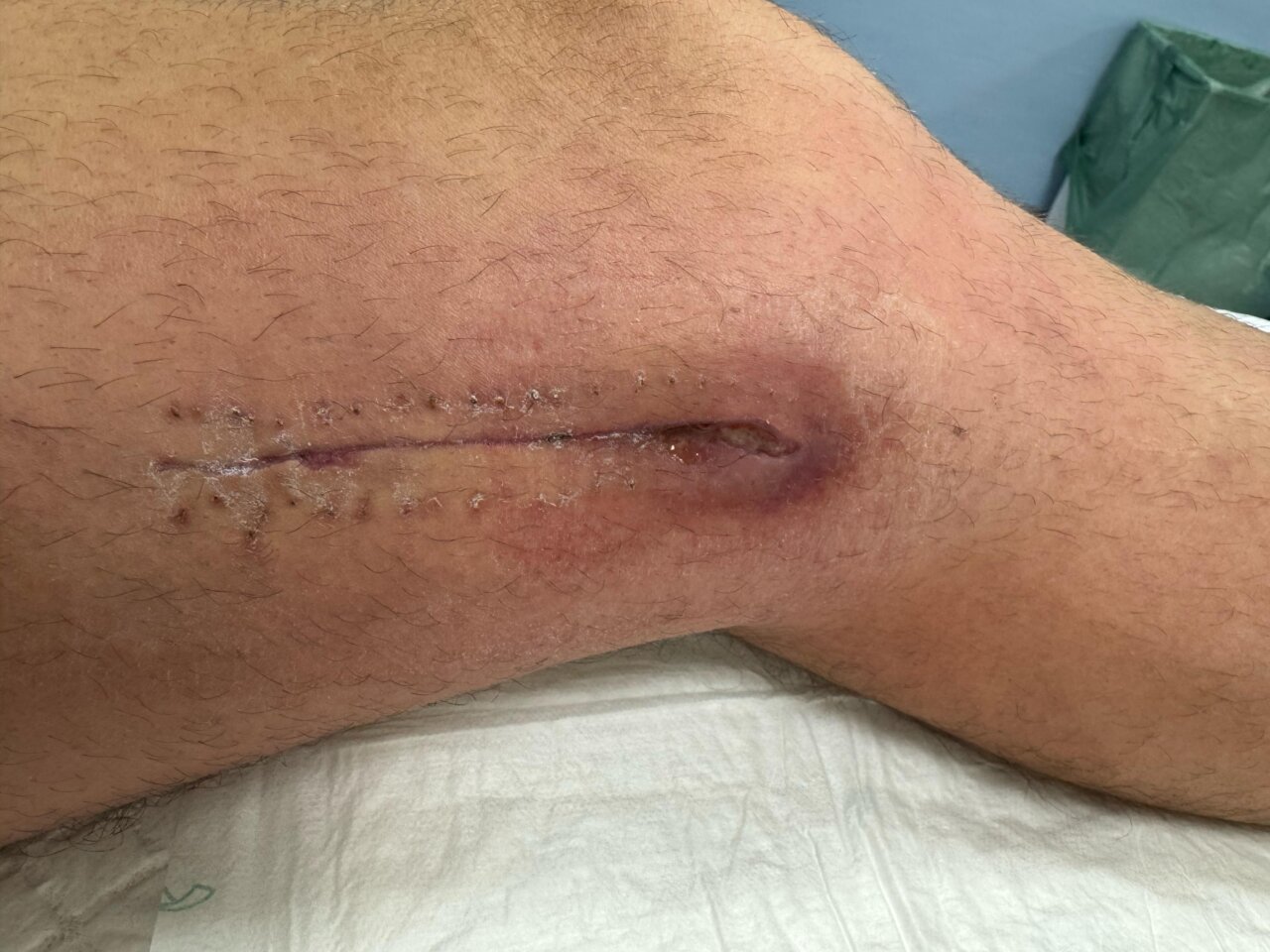 Alberto Durán, hospitalizado de urgencia de nuevo por "un cuadro febril severo y una infección" en la pierna