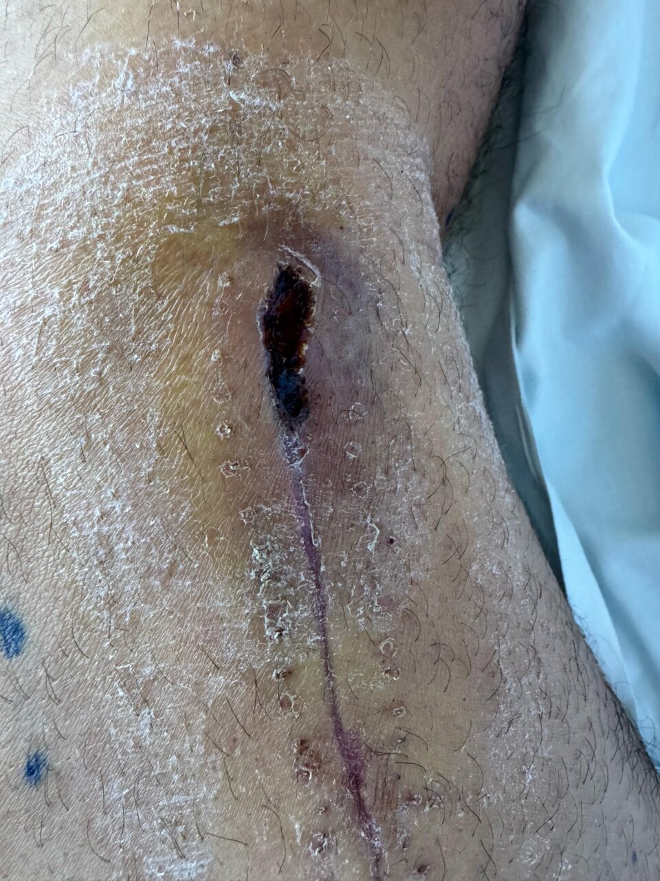 Alberto Durán, en aislamiento tras serle detectadas dos bacterias contagiosas
